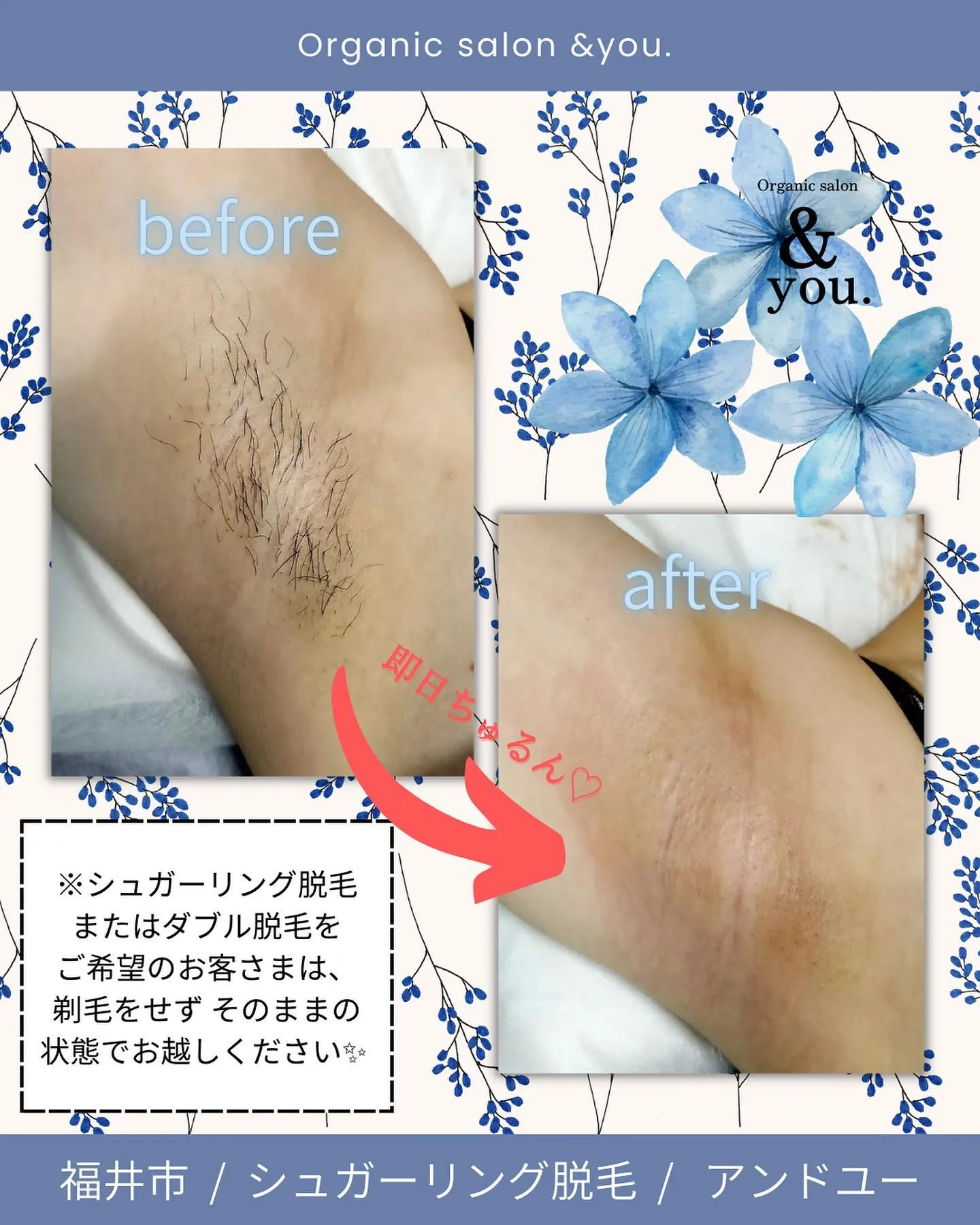【両脇シュガーリング脱毛】