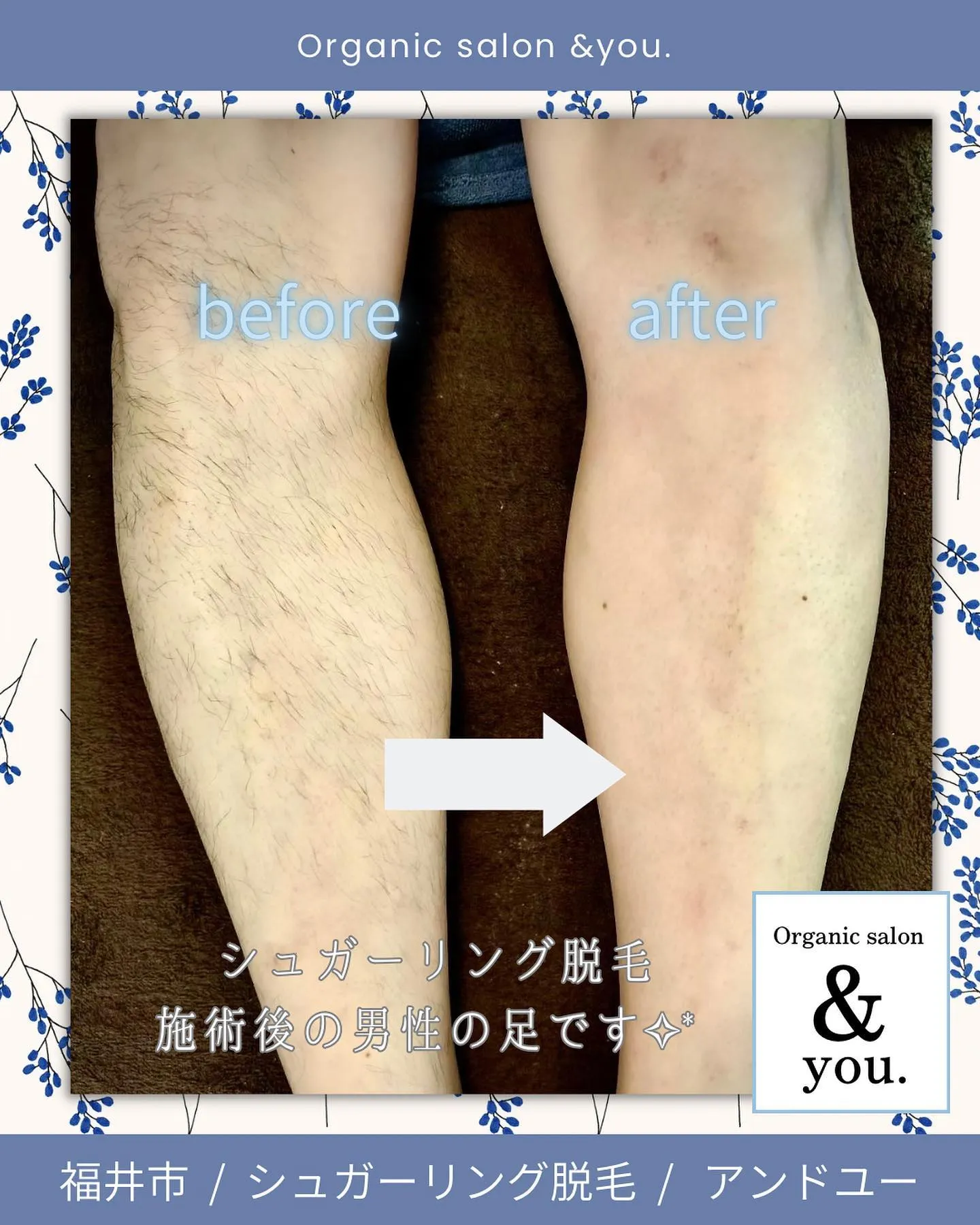 【メンズシュガーリング脱毛】